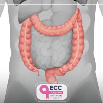 تكلفة عملية استئصال القولون