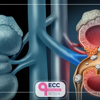 تكلفة عملية استئصال الكلى