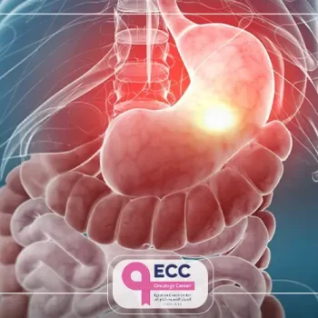 سرطان المعده هل له علاج