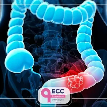 طريقة علاج سرطان القولون