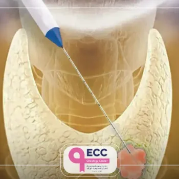 علاج اورام الغده الدرقيه بالتردد الحراري