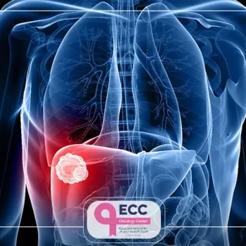 علاج اورام الكبد الحميدة