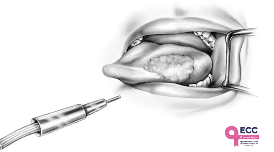 عملية استئصال سرطان اللسان