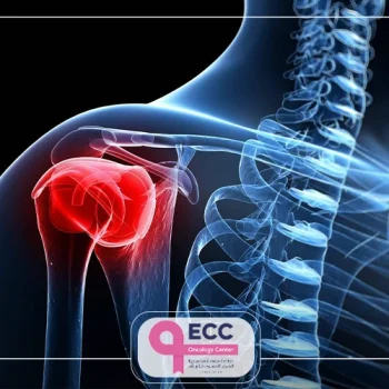 سرطان العظام ونسبة الشفاء